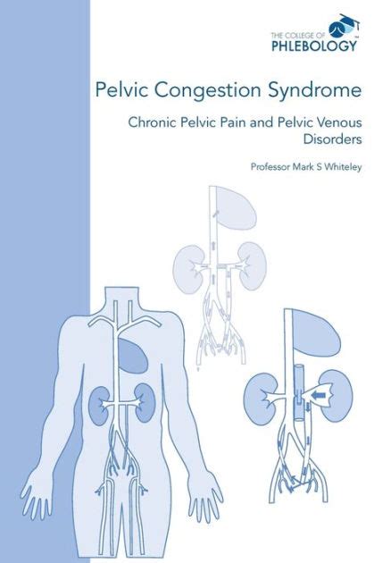 Pelvic Congestion Syndrome Chronic Pelvic Pain And Pelvic Venous