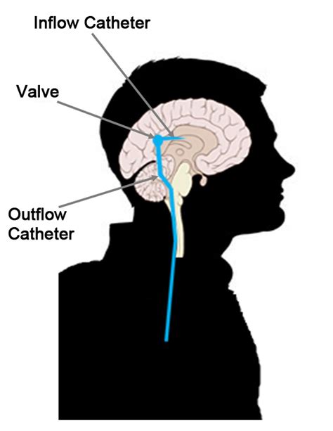 Cerebral Spinal Fluid Csf Shunt Systems Fda