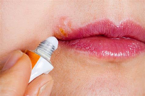 Seriously, we're gonna remove this shit. 5 Cold Sore Triggers You May Not Have Considered ...