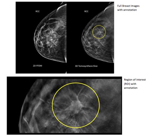 Regular breast cancer screenings are essential to a woman's health. 3-D mammogram scans may find more breast cancer | Daily ...