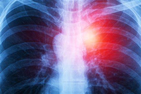 Most diagnosed cases are pleural mesothelioma, which forms on the lining of the lungs. Mesothelioma Lawyers | The Dominguez Firm