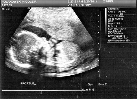(= when did mrs hill die?) 9 the weather is dry. 20 Week Anatomy Ultrasound