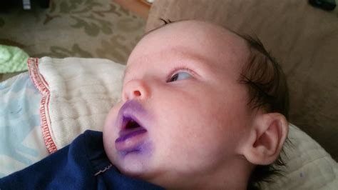 Gentian Violet For Thrush Question Babycenter