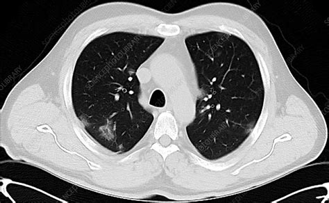 Lungs Affected By Covid 19 Pneumonia Ct Scan Stock Image C0485727