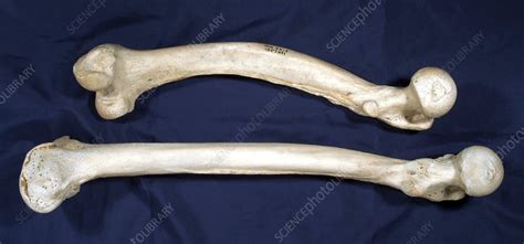 Normal And Rickets Affected Bones Stock Image C0140351 Science