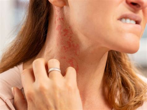 Types Of Itchy Rash Images