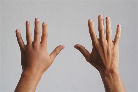 Treating Hand Injuries Or Hand Swelling Physicians Immediate Care