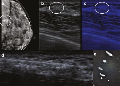 Scielo Brasil Ultrasound Guided Biopsy Of Breast Calcifications Using A New Image Processing