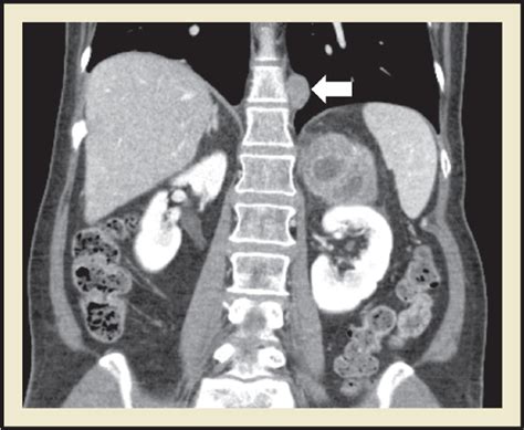 Juxta Adrenal Ancient Schwannoma A Rare Retroperitoneal Tumor