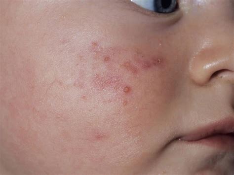 Visual Guide To Childrens Rashes And Skin Conditions Babycenter