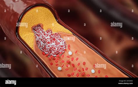 Arteria Enferma O Vaso Sanguíneo Obstruido Por El Colesterol O Placa De
