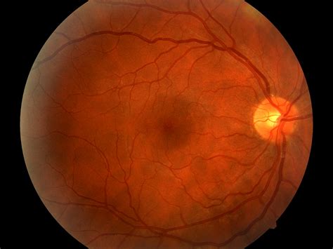 Diabetic Retinopathy Low Vision Specialists