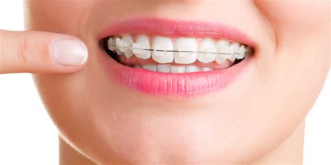 Braces hurt for a couple of days after getting them. How to Reduce the Pain and Discomfort of Braces - ToothStars