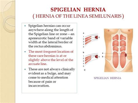 Pin On Hernias Groin