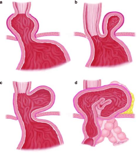 Types Of Hiatal Hernias A Type I Sliding Hernia B Download Scientific Diagram