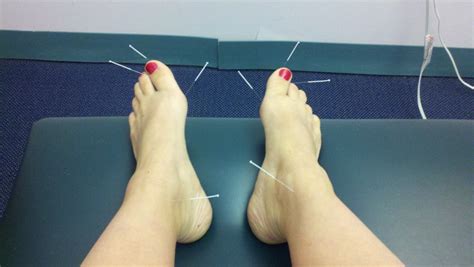 Plantar Fasciitis- A pain in the foot | Clayton Chiropractic Center