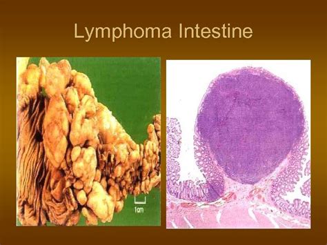 Lymphoma Haematological Neoplasia — Overview N Leukemias