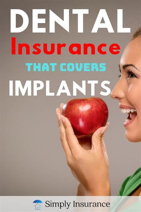 Dental implant many dental insurance plans cover. Dental Insurance That Covers Implants in 2020 // No Waiting! | Dental insurance plans, Dental ...