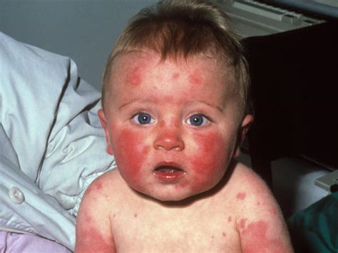 Childhood Rashes And Skin Conditions Photos Babycenter Canada