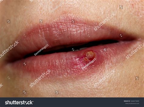 Case Pyogenic Granuloma On Lower Lip Foto Stock 1646473009 Shutterstock