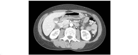 Abdominal Computed Tomography Shows Gallstones With Gallbladder Wall