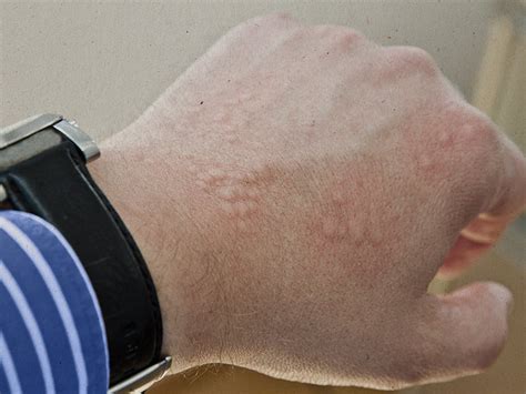 Rashes That Look Like Scabies Causes Symptoms And Treatment