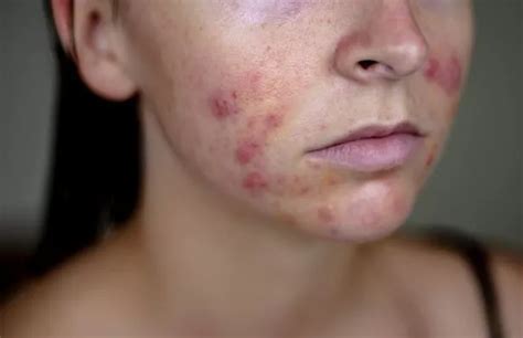 The Teenager Whose Acne Was So Bad She Wouldnt Even Let Her Own Gran