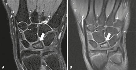 Scielo Brasil Avascular Necrosis Radiological Findings And Main