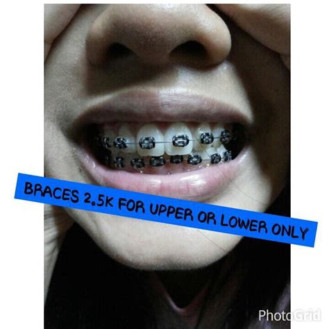 Cheap And Affordable Braces Manila