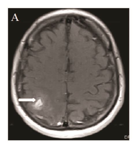 Mri Brain A An Axial Postcontrast Enhanced Fat Saturated