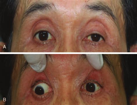 Clinical Photograph Of 62 Year Old Man With Sudden Onset Diplopia