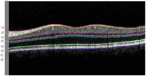 Exemplary Oct B Scan From Spectralis Sd Oct Showing Eight Intraretinal