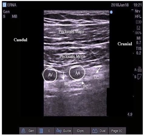 Ultrasound Guided Infraclavicular Brachial Plexus Block Wfsa Resources