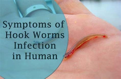 What Are The Symptoms Of Hookworms Infection In Human How To Cure