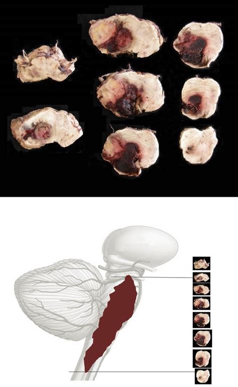 Brainstem Encephalitis