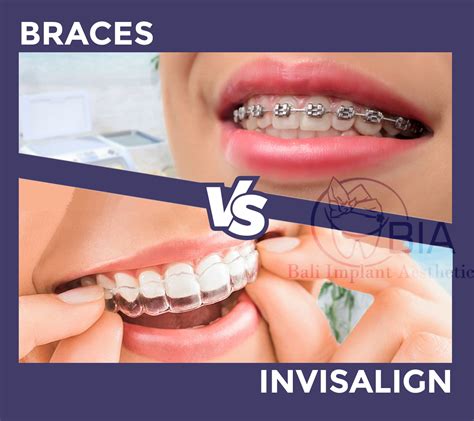 Metal Braces Vs Invisalign Bali Implant Aesthetic Bia Dental Center