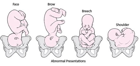 Figure Position And Presentation Of The Fetus Msd Manual Consumer Version