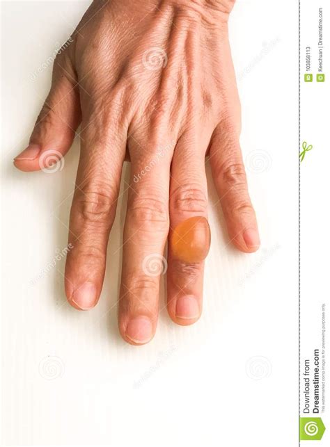 Finger With Painful Inflammed Fluid Filled Blister Stock Image Image