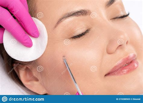 A Procedure For Cleansing The Skin Of The Face From Blackheads And Acne