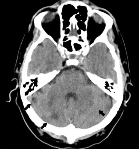 Admission Brain Ct Showing Multiple And Bilateral Cerebellar Ischemic