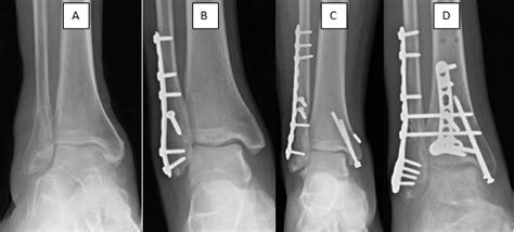 Ankle Fracture Orthopaedic Trauma Association Ota