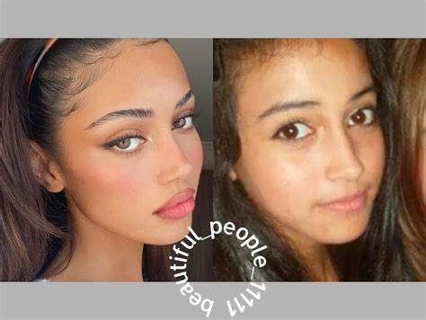 Cindy Kimberly Before And After Rhinoplasty Nose Jobs Eye Lift Surgery