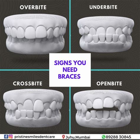 Check Out The Six Signs That You May Need Braces Smile Dental Oral