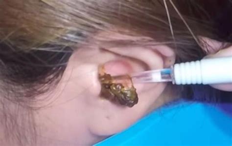 Ear Wax Removal Videos Are The New Pimple Popping Videos—check Em Out