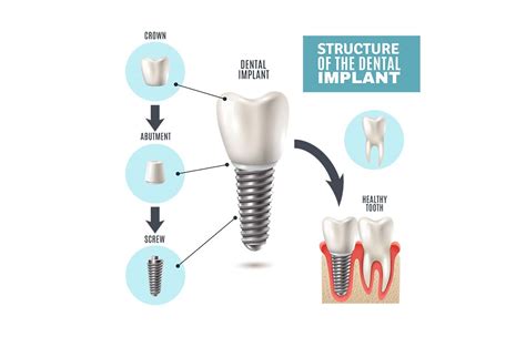 The Secret Facts About Dental Implant Costs Dental Treatment Central