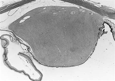 Pathology Outlines Old Uvea Leiomyoma Ciliary Body Iris