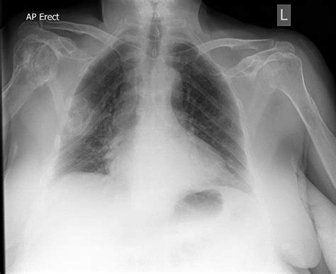 Hereditary Multiple Exostosis An Incidental Finding On A Chest