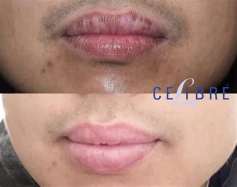 Lips Spots Removal Dark And Sun Spots On Lips