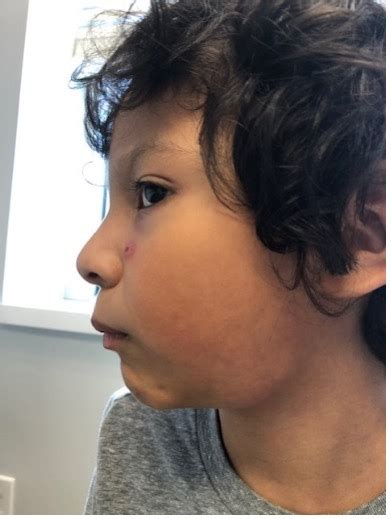 Unilateral Submandibular Lymphadenopathy In A 7 Year Old Boy