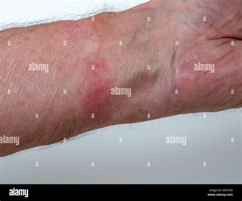 Dermatite Allergique De Contact Banque De Photographies Et Dimages à